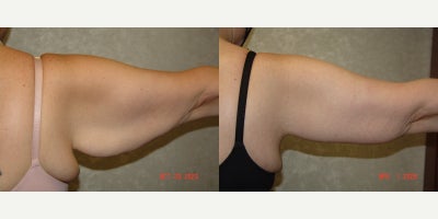 Tummy Tuck before and after photo