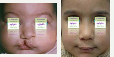 Cleft Lip And Palate Repair before and after photo