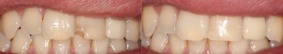 Dental Bonding before and after photo