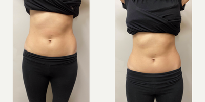 Emsculpt before and after photo