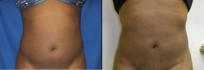 Liposuction before and after photo