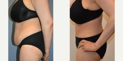 Liposuction before and after photo