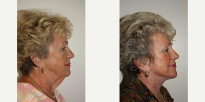 Lower Facelift before and after photo
