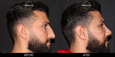 Rhinoplasty before and after photo