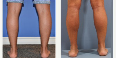 Calf Implant before and after photo