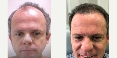 Hair Transplant before and after photo
