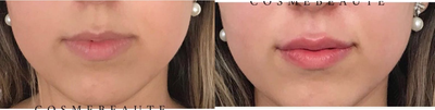 Juvederm before and after photo