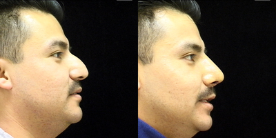 Rhinoplasty before and after photo