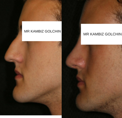 Rhinoplasty before and after photo