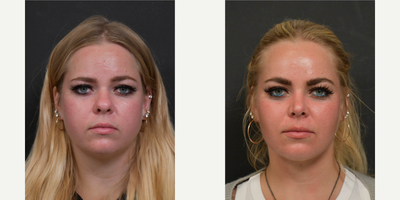Rhinoplasty before and after photo