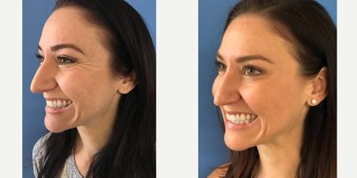 Botox before and after photo