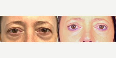 Brow Lift before and after photo