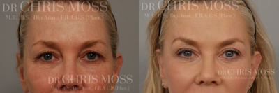 Eyelid Surgery before and after photo