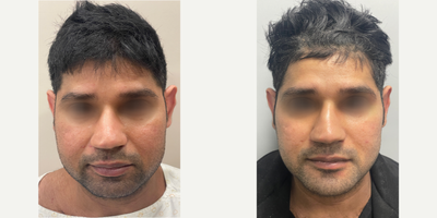 Chin Implant before and after photo