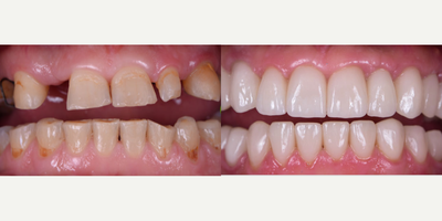 Dental Implants before and after photo