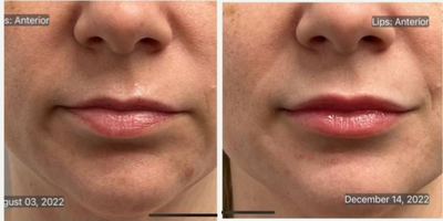 Lip Fillers before and after photo