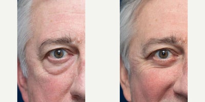 Eyelid Surgery before and after photo
