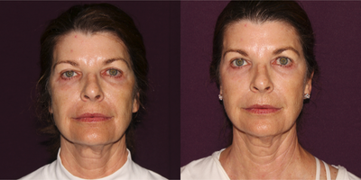 Halo Laser before and after photo