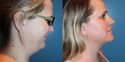Liposculpture before and after photo