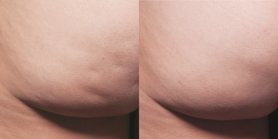 Cellfina before and after photo