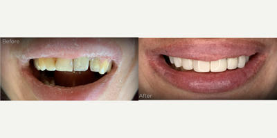 Dental Bonding before and after photo