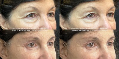 Eyelid Surgery before and after photo