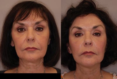 Facelift before and after photo