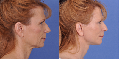 Facelift before and after photo