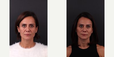 Facelift before and after photo
