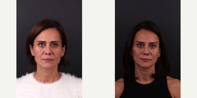 Facelift before and after photo
