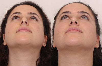 Septoplasty before and after photo