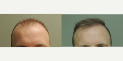Hair Transplant before and after photo