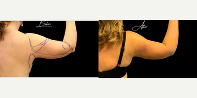 Renuvion before and after photo