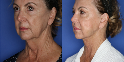 ThermiTight before and after photo