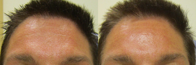 Belotero before and after photo