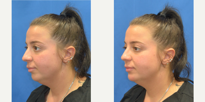 Dermal Fillers before and after photo