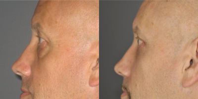 Eyelid Surgery before and after photo