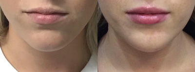 Lip Fillers before and after photo