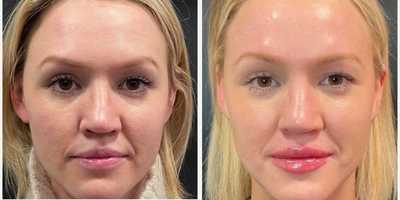 Lip Fillers before and after photo