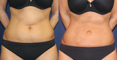 Liposuction before and after photo