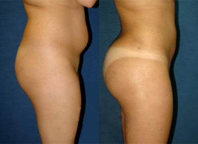 Brazilian Butt Lift before and after photo