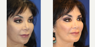 Chin Implant before and after photo