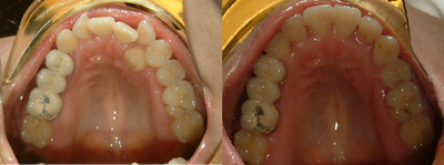 Clear Braces before and after photo