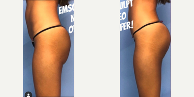 Emsculpt before and after photo