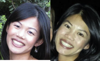 Eyelid Surgery before and after photo