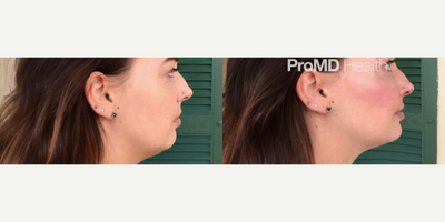 Chin Filler before and after photo