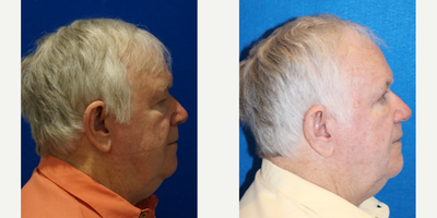 Eyelid Surgery before and after photo