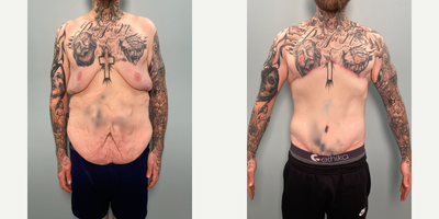 Gynecomastia Surgery before and after photo
