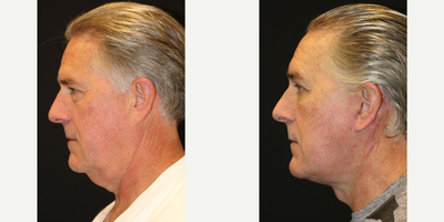 Neck Lift before and after photo
