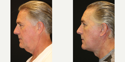 Neck Lift before and after photo